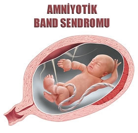 Amniyotik-Band-Sendromu_90e3d.jpg