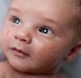 Bebeklerde-Akne-Problemi_988c5.jpg